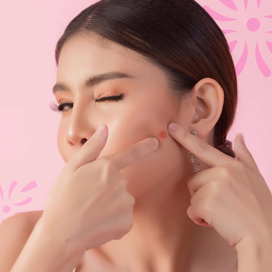 Acne Removal - How to Get Rid of Acne on Dry Skin